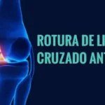 Rotura de ligamento cruzado anterior: todo lo que debes saber