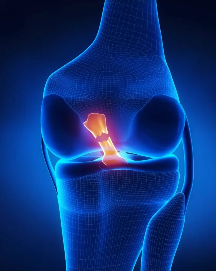 rotura de ligamento cruzado anterior