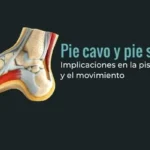Pie cavo y pie supinador: implicaciones en la pisada y el movimiento