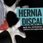Hernia discal: qué es, síntomas y cómo recuperarte