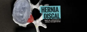 hernia discal
