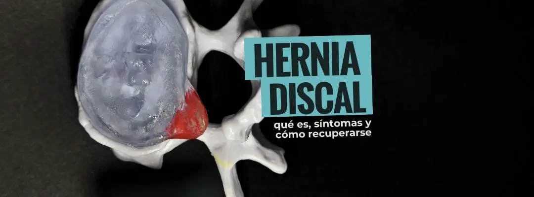 Hernia discal: qué es, síntomas y cómo recuperarte