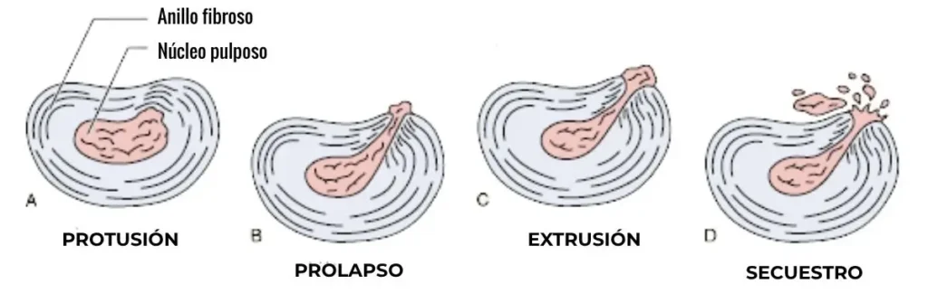 tipos de hernia discal, hernia discal